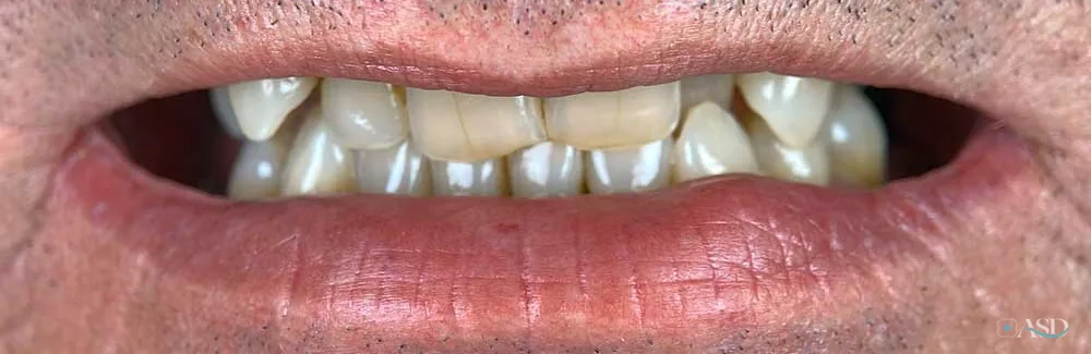 Smile-Makeover-Fall, vor der Behandlung
