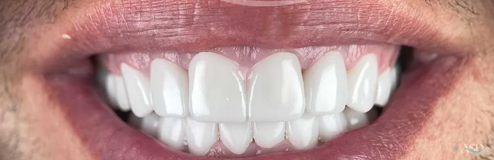 Smile-Makeover-Fall, nach der Behandlung