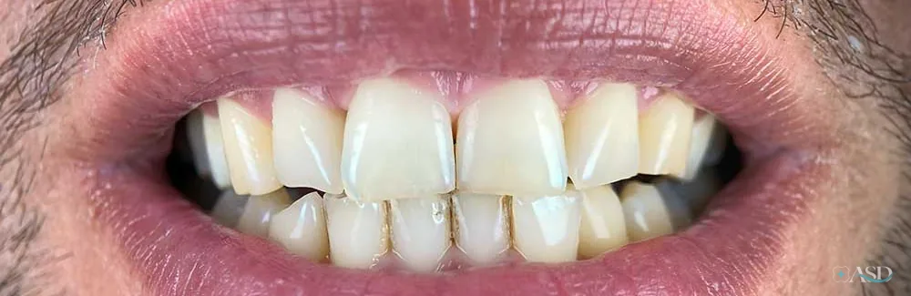 Smile-Makeover-Fall, vor der Behandlung