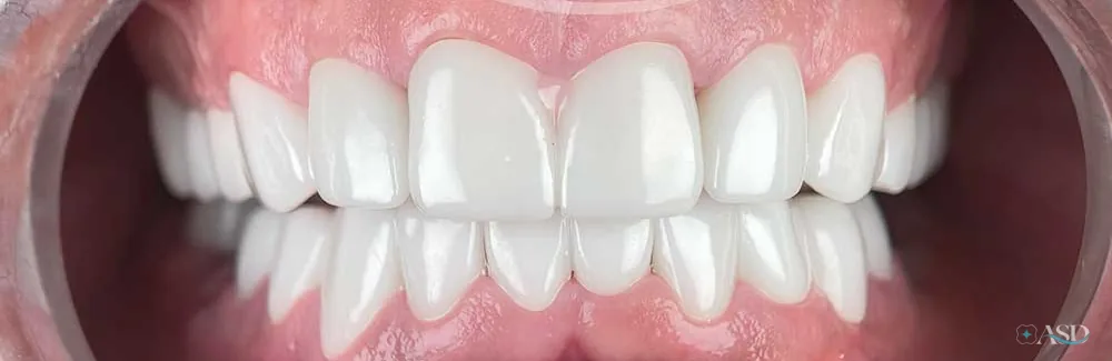 Smile-Makeover-Fall, nach der Behandlung