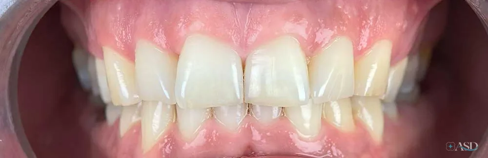 Smile-Makeover-Fall, vor der Behandlung
