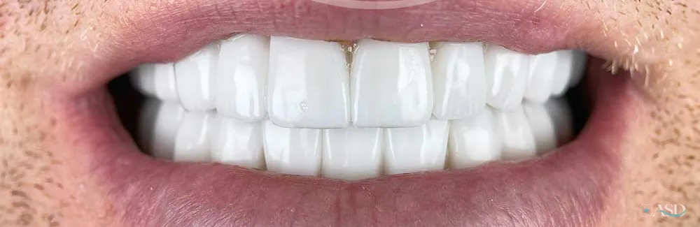 Smile-Makeover-Fall, nach der Behandlung