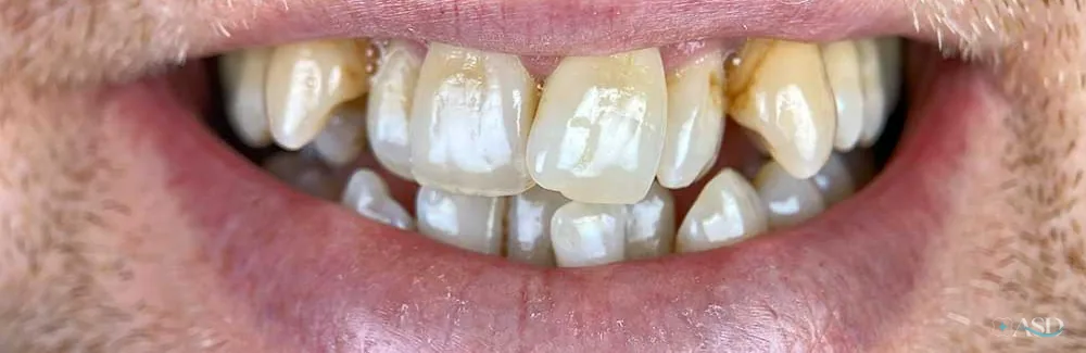 Smile-Makeover-Fall, vor der Behandlung