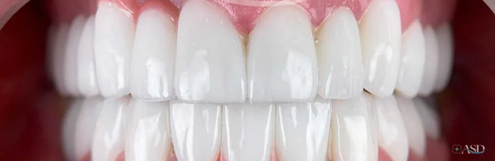 Smile-Makeover-Fall, nach der Behandlung