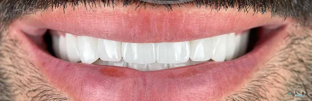 Smile-Makeover-Fall, nach der Behandlung