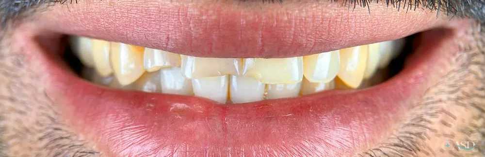 Smile-Makeover-Fall, vor der Behandlung