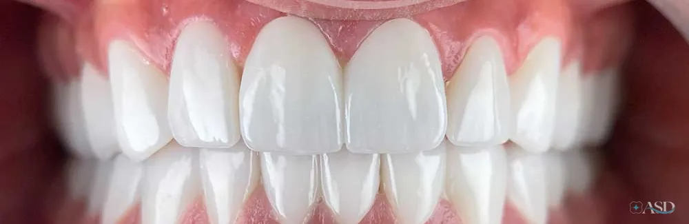Smile-Makeover-Fall, nach der Behandlung