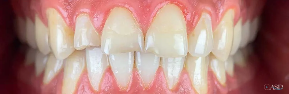 Smile-Makeover-Fall, vor der Behandlung