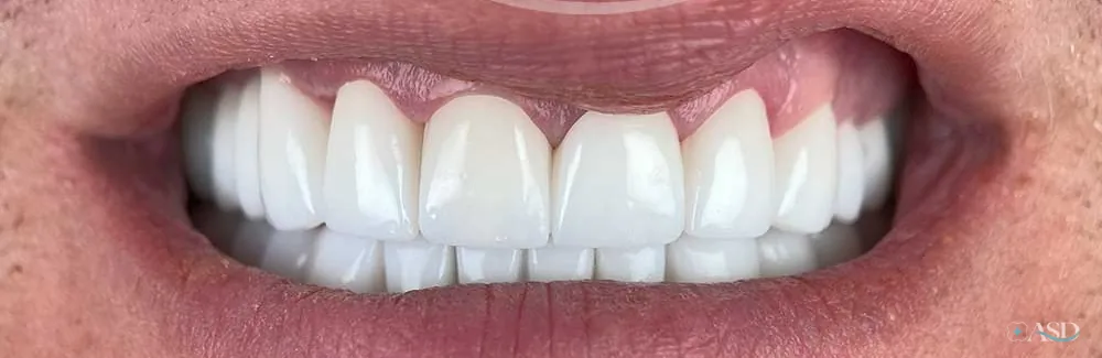 Smile-Makeover-Fall, nach der Behandlung