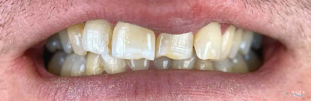 Smile-Makeover-Fall, vor der Behandlung