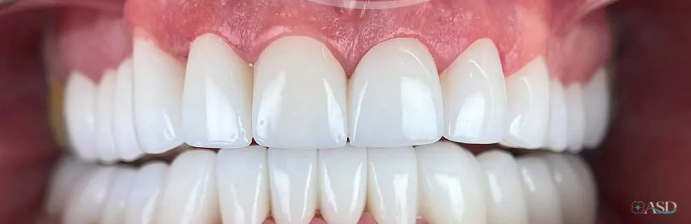 Smile-Makeover-Fall, nach der Behandlung