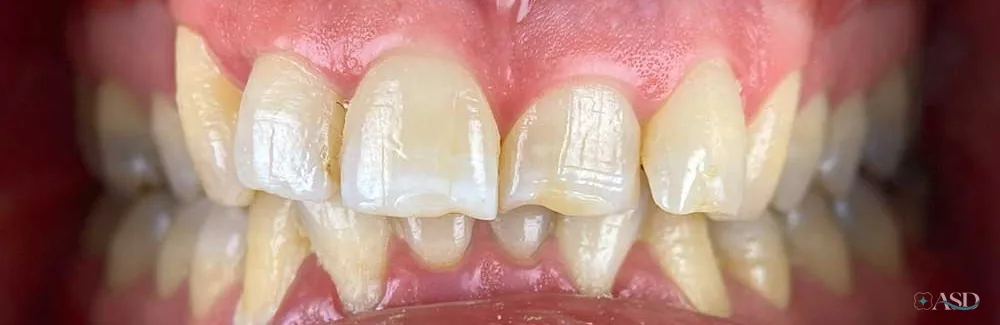 Smile-Makeover-Fall, vor der Behandlung