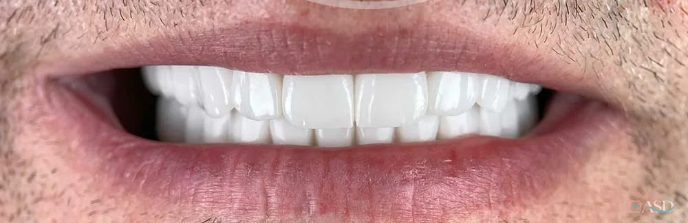 Smile-Makeover-Fall, nach der Behandlung