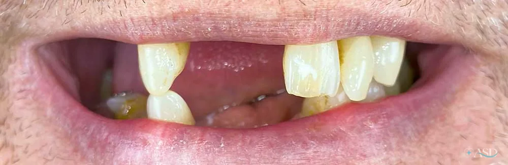 Smile-Makeover-Fall, vor der Behandlung