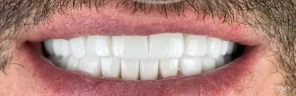 Smile-Makeover-Fall, nach der Behandlung