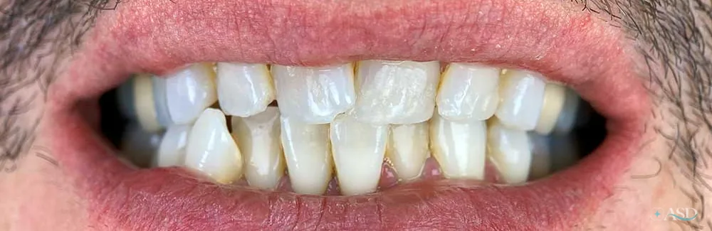 Smile-Makeover-Fall, vor der Behandlung