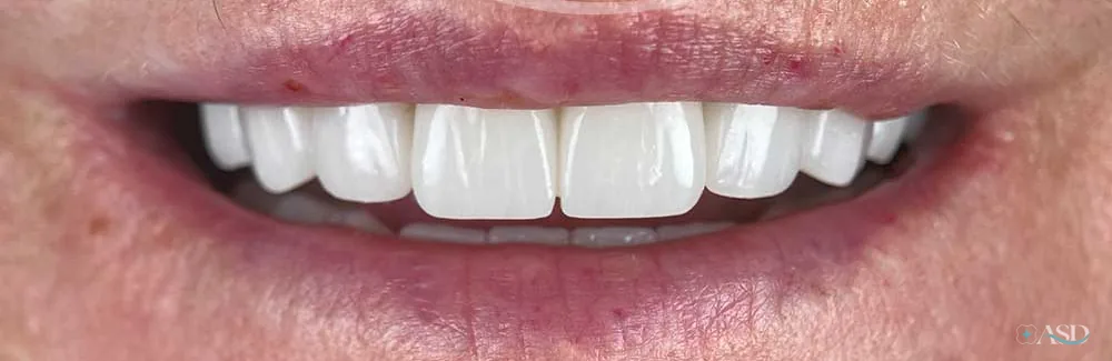 Smile-Makeover-Fall, nach der Behandlung