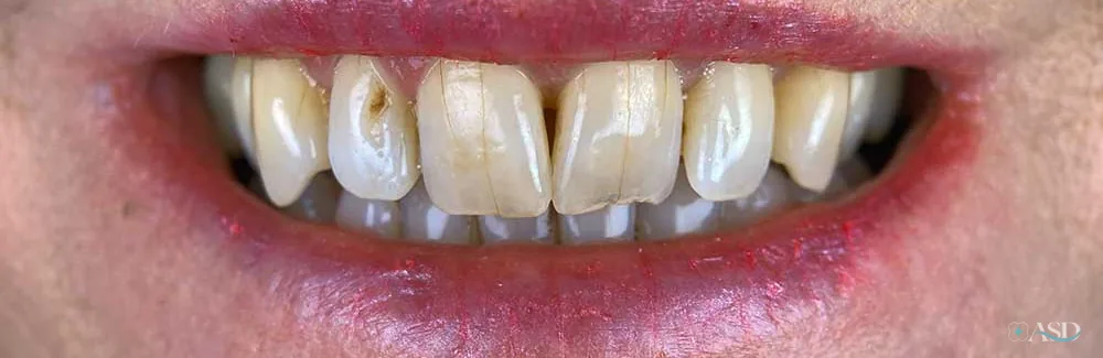 Smile-Makeover-Fall, vor der Behandlung