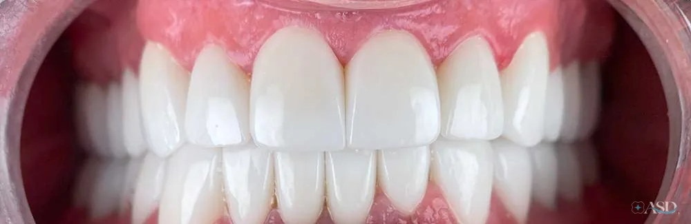 Smile-Makeover-Fall, nach der Behandlung