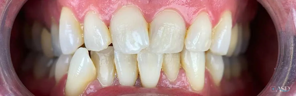 Smile-Makeover-Fall, vor der Behandlung
