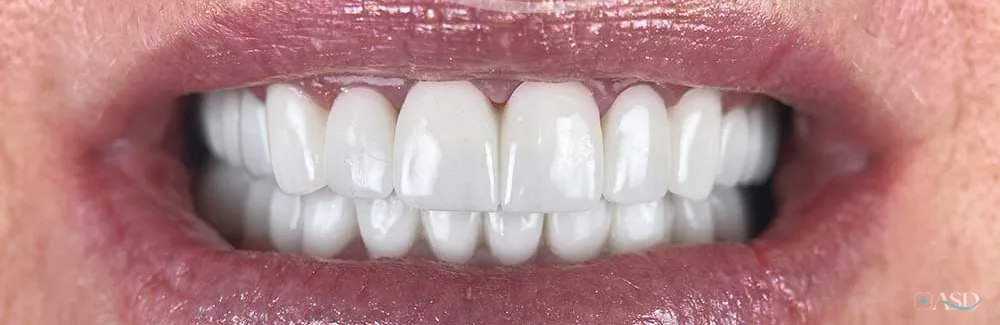 Smile-Makeover-Fall, nach der Behandlung