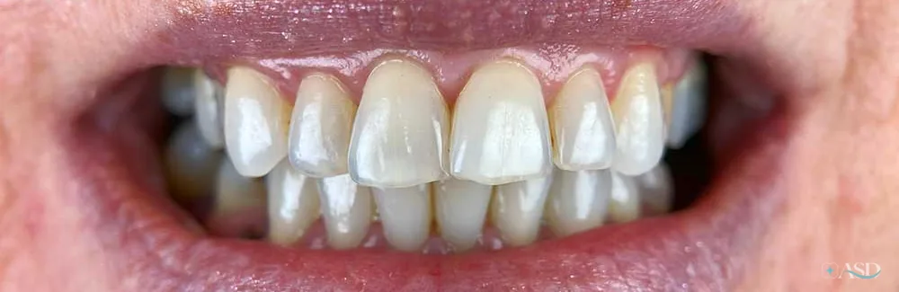 Smile-Makeover-Fall, vor der Behandlung