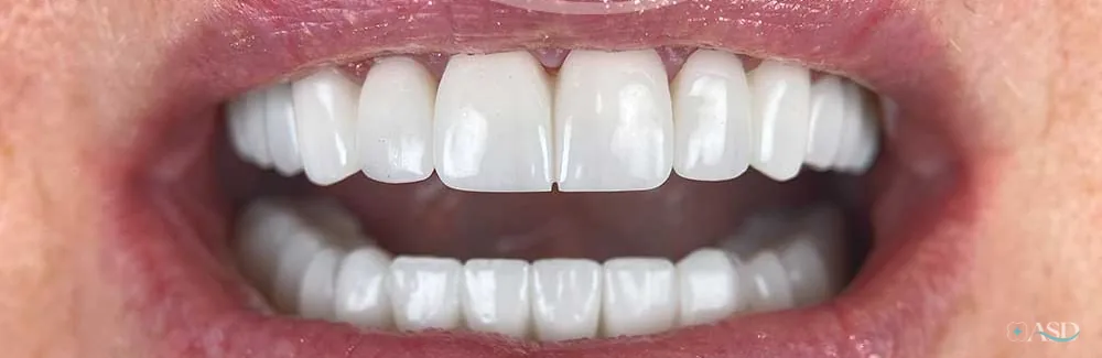 Smile-Makeover-Fall, nach der Behandlung