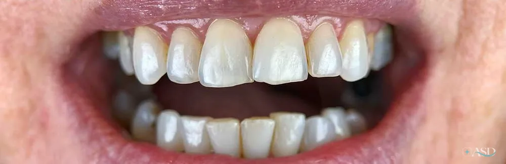 Smile-Makeover-Fall, vor der Behandlung