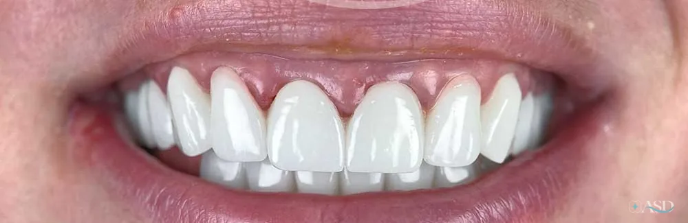 Smile-Makeover-Fall, nach der Behandlung