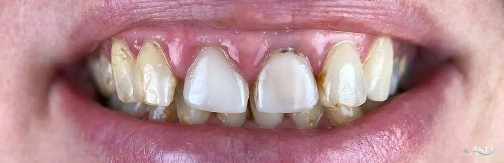 Smile-Makeover-Fall, vor der Behandlung