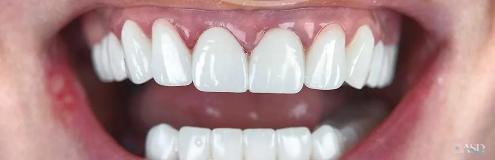 Smile-Makeover-Fall, nach der Behandlung