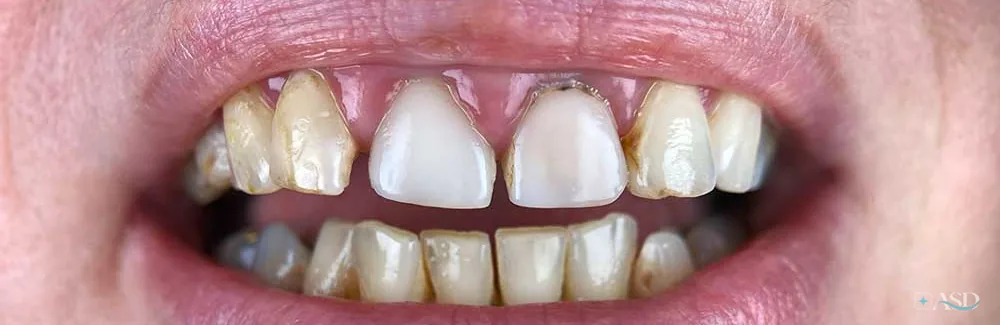 Smile-Makeover-Fall, vor der Behandlung
