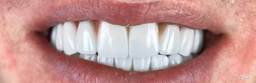 Smile-Makeover-Fall, nach der Behandlung