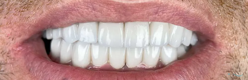 Smile-Makeover-Fall, nach der Behandlung