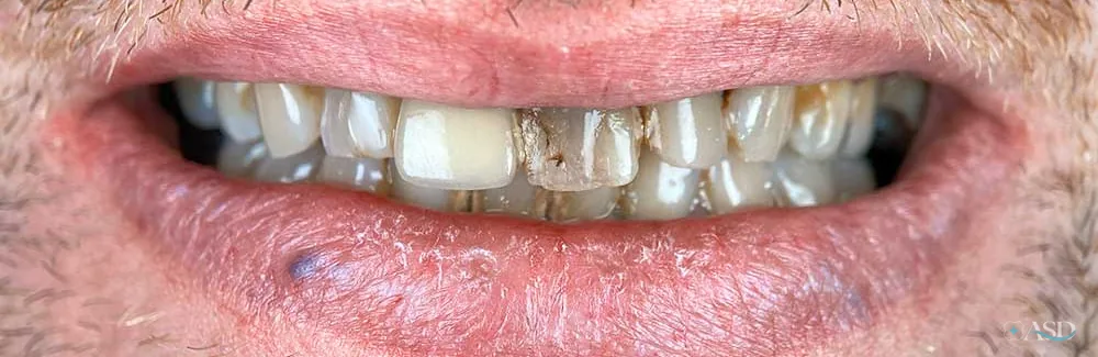 Smile-Makeover-Fall, vor der Behandlung