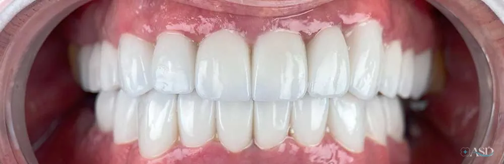 Smile-Makeover-Fall, nach der Behandlung