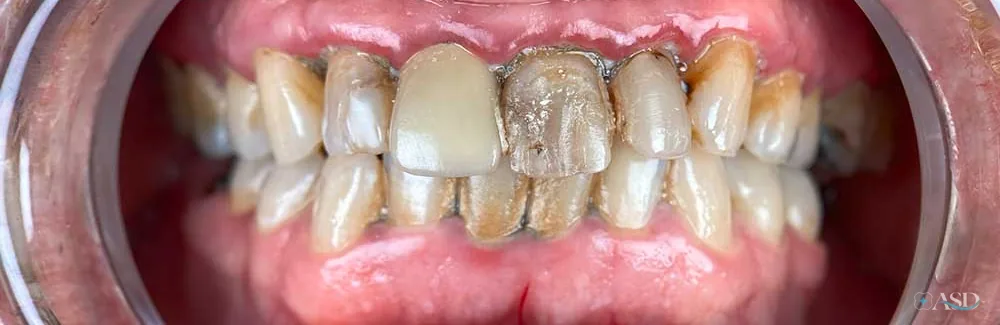 Smile-Makeover-Fall, vor der Behandlung