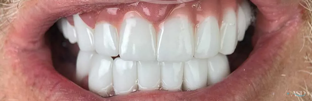 Smile-Makeover-Fall, nach der Behandlung