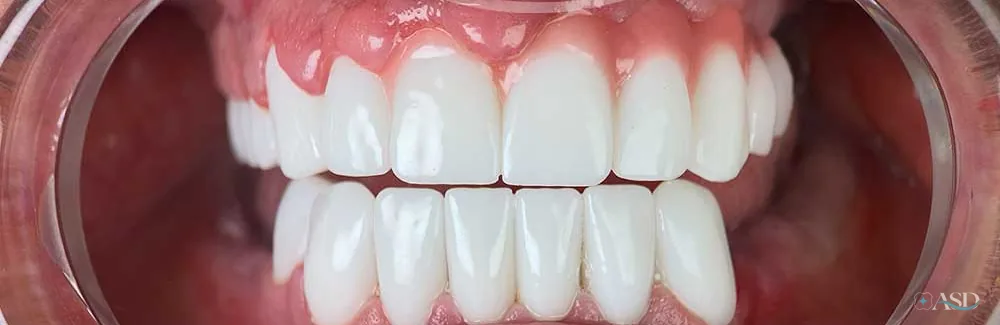Smile-Makeover-Fall, nach der Behandlung