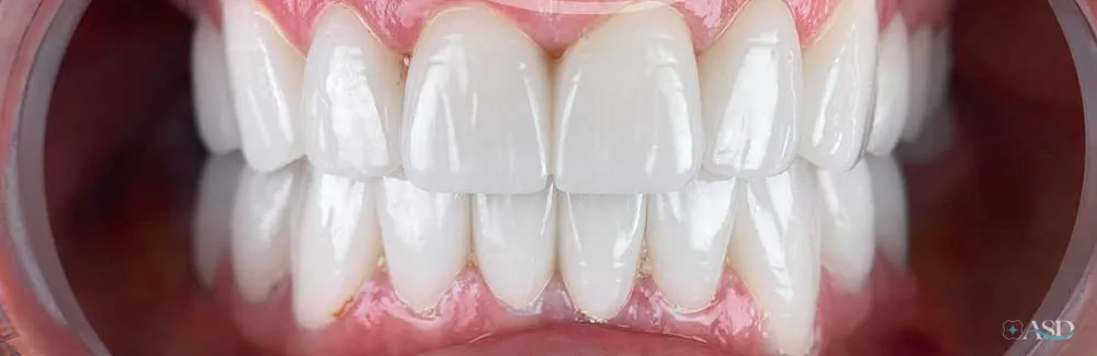 Smile-Makeover-Fall, nach der Behandlung