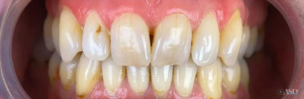 Smile-Makeover-Fall, vor der Behandlung