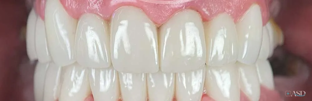 Smile-Makeover-Fall, nach der Behandlung