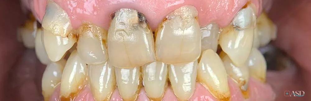 Smile-Makeover-Fall, vor der Behandlung