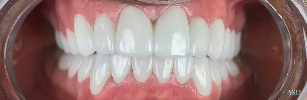 Smile-Makeover-Fall, nach der Behandlung