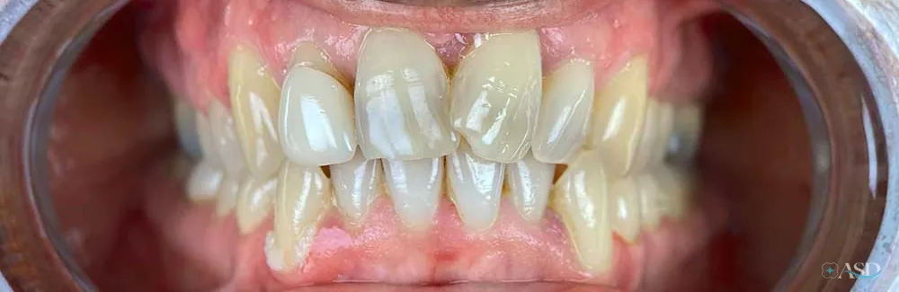 Smile-Makeover-Fall, vor der Behandlung