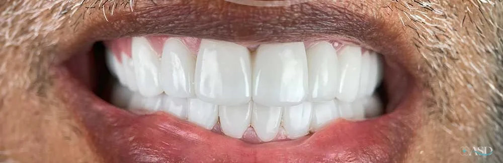 Smile-Makeover-Fall, nach der Behandlung
