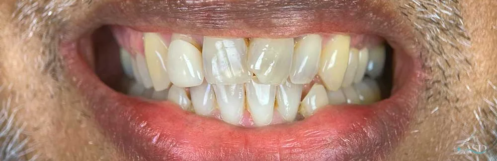 Smile-Makeover-Fall, vor der Behandlung