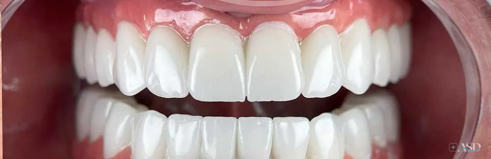 Smile-Makeover-Fall, nach der Behandlung