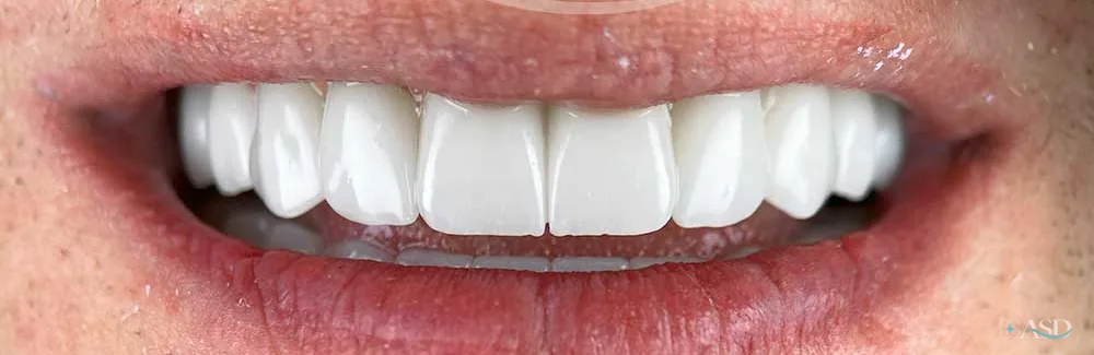 Smile-Makeover-Fall, nach der Behandlung