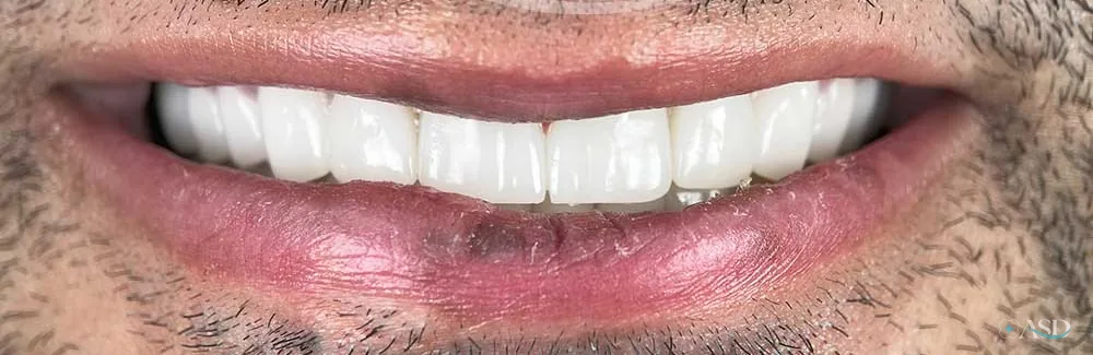 Smile-Makeover-Fall, nach der Behandlung